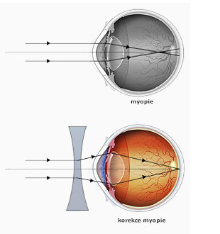 Miopie astigmatism